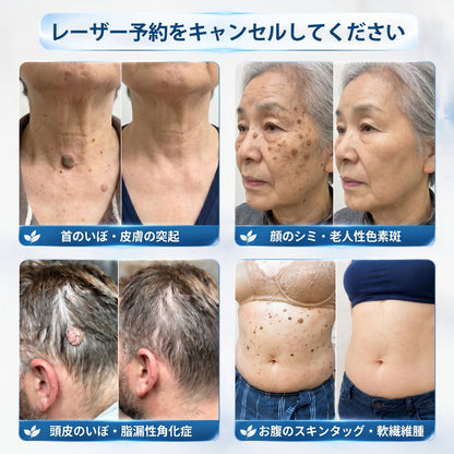 𝐏𝐢𝐜𝐝𝐨® 𝟕日間 スキンタッグ＆シミ除去リムーバー（ロールオンタイプ：無痛・傷跡ゼロ🤩