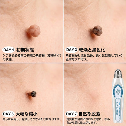 𝐏𝐢𝐜𝐝𝐨® 𝟕日間 スキンタッグ＆シミ除去リムーバー（ロールオンタイプ：無痛・傷跡ゼロ🤩