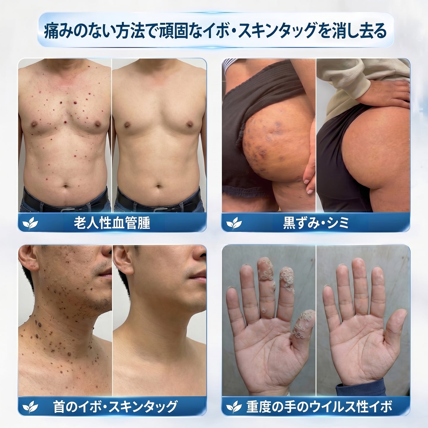 𝐏𝐢𝐜𝐝𝐨® 𝟕日間 スキンタッグ＆シミ除去リムーバー（ロールオンタイプ：無痛・傷跡ゼロ🤩